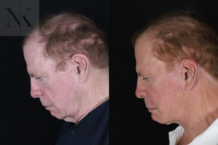Before & After Chin Implant Case 168 Left Side Down View in Wethersfield, Hartford, Nebraska