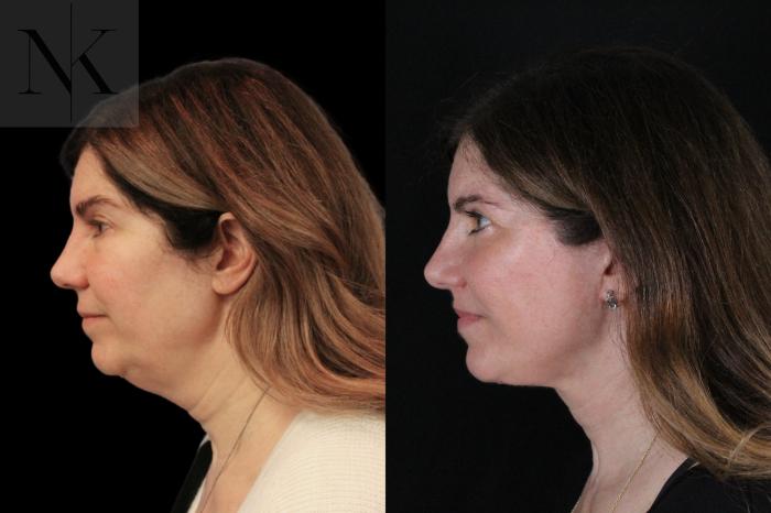 Before & After Lip Lift Case 171 Left Side View in Wethersfield, Hartford, Nebraska