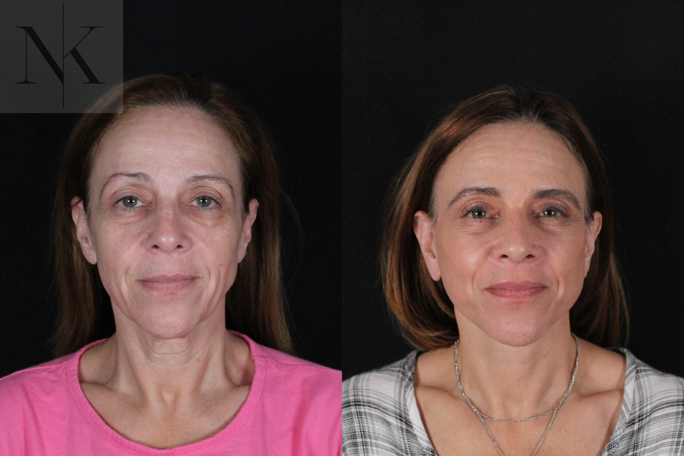 Before & After Deep Plane Facelift Case 219 Front View in Wethersfield, Hartford, Nebraska