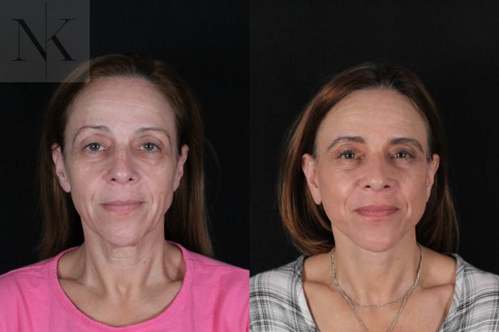 Before & After Deep Plane Facelift Case 219 Front View in Wethersfield, Hartford, Nebraska