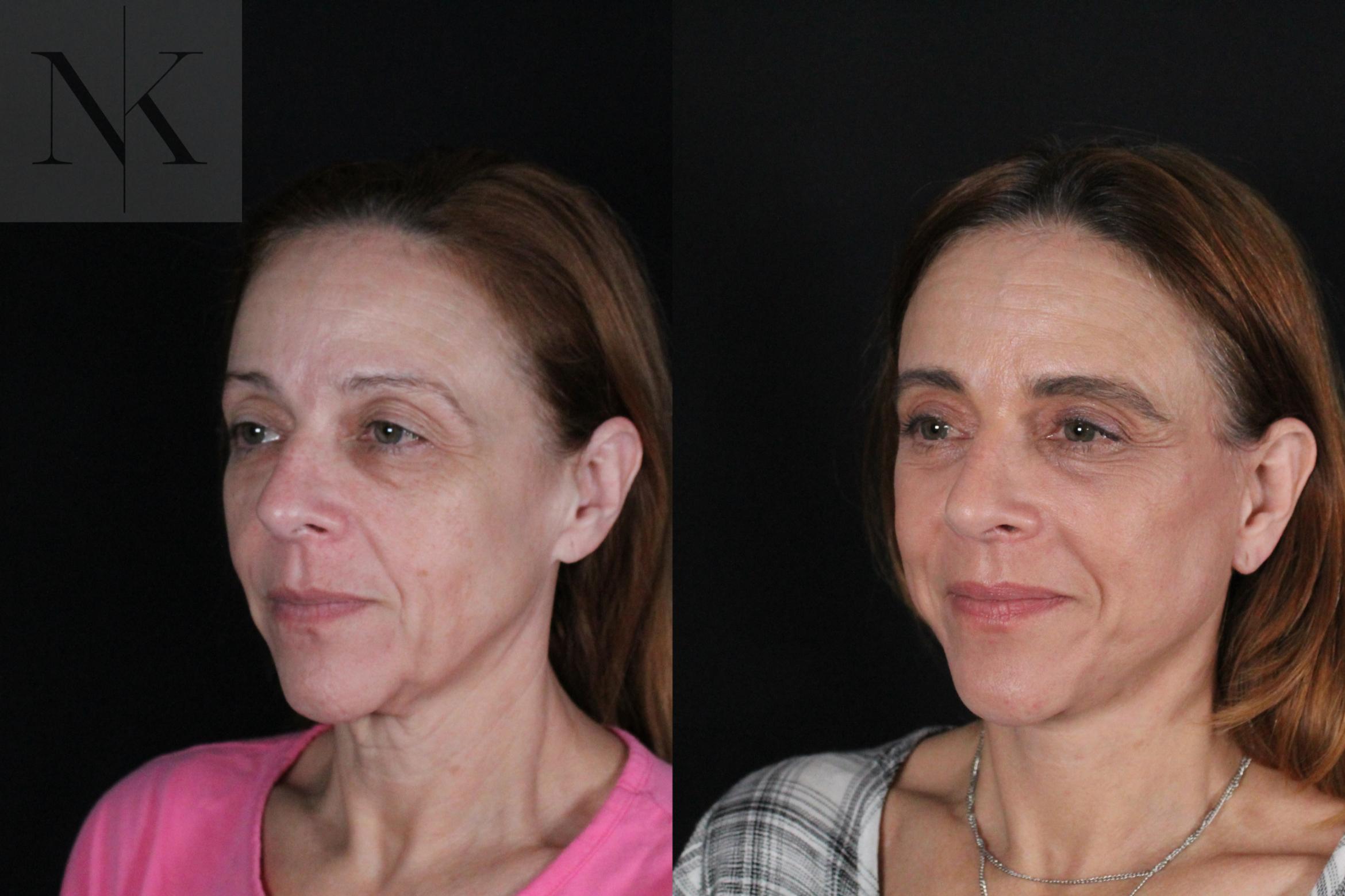 Before & After Deep Plane Facelift Case 219 Left Oblique View in Wethersfield, Hartford, Nebraska