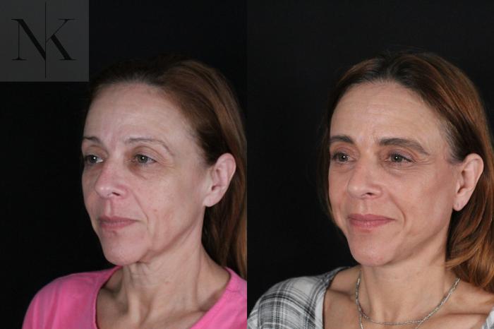 Before & After Deep Plane Facelift Case 219 Left Oblique View in Wethersfield, Hartford, Nebraska
