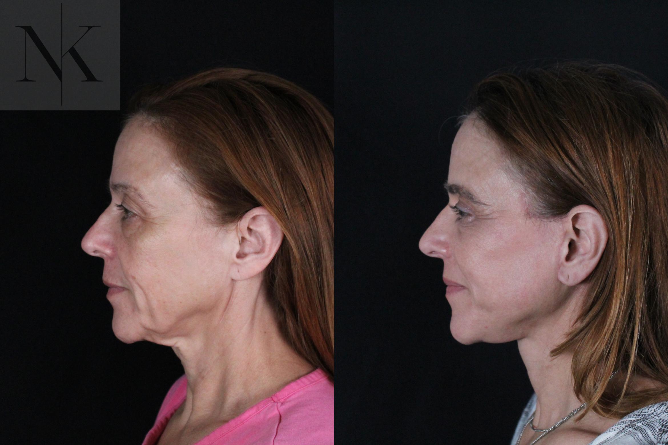 Before & After Deep Plane Facelift Case 219 Left Side View in Wethersfield, Hartford, Nebraska