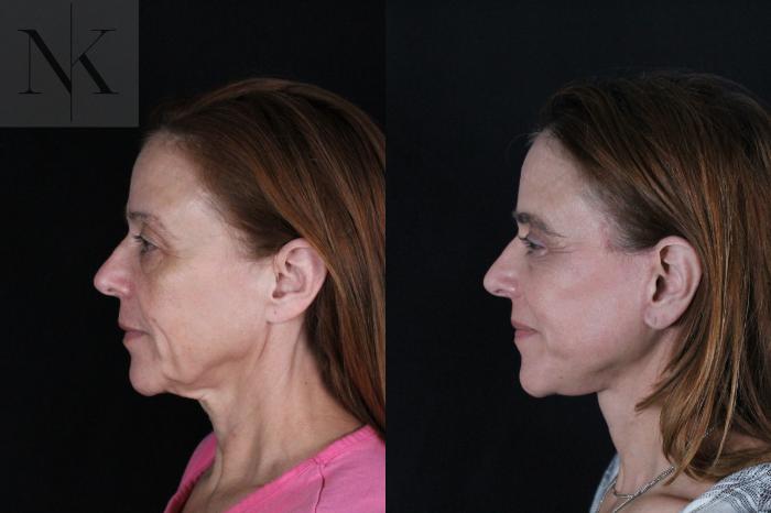 Before & After Deep Plane Facelift Case 219 Left Side View in Wethersfield, Hartford, Nebraska