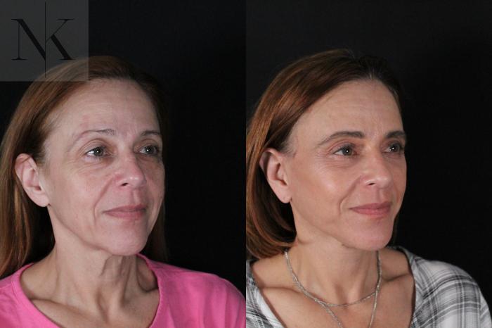 Before & After Deep Plane Facelift Case 219 Right Oblique View in Wethersfield, Hartford, Nebraska