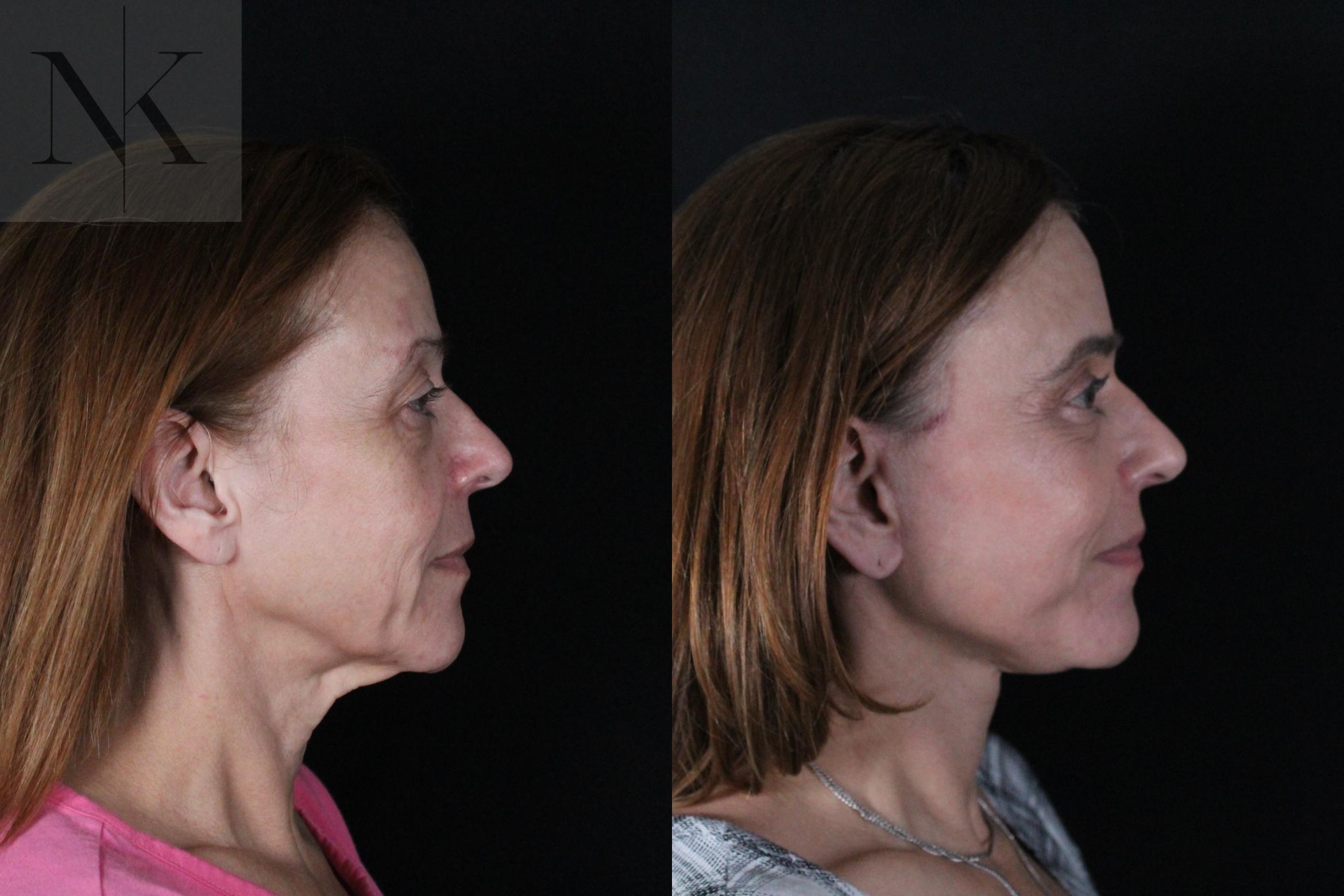 Before & After Deep Plane Facelift Case 219 Right Side View in Wethersfield, Hartford, Nebraska