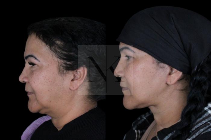 Before & After Deep Neck Sculpting Case 3 Left Side View in Wethersfield, Hartford, Nebraska