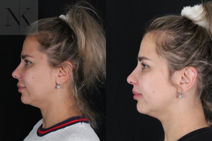 Before & After Lip Lift Case 173 Left Side View in Wethersfield, Hartford, Nebraska