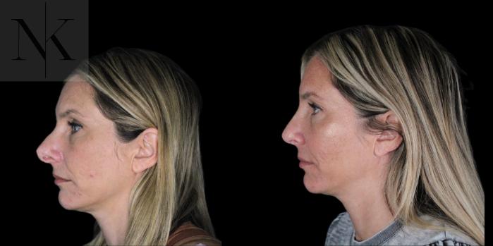 Before & After Revision Rhinoplasty Case 180 Left Side View in Wethersfield, Hartford, Nebraska