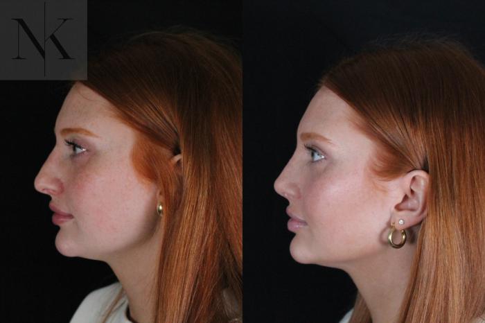 Before & After Revision Rhinoplasty Case 181 Left Side View in Wethersfield, Hartford, Nebraska