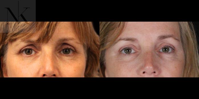 Before & After Brow Lift Case 158 Front View in Wethersfield, Hartford, Nebraska