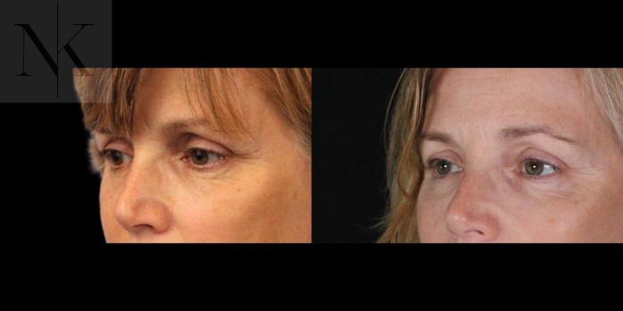 Before & After Brow Lift Case 158 Left Oblique View in Wethersfield, Hartford, Nebraska