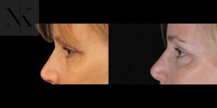 Before & After Brow Lift Case 158 Left Side View in Wethersfield, Hartford, Nebraska
