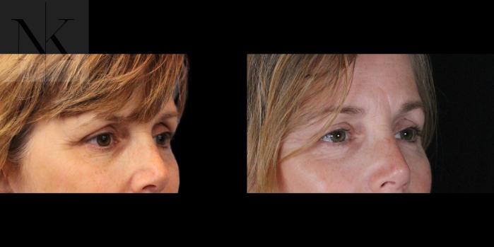 Before & After Brow Lift Case 158 Right Oblique View in Wethersfield, Hartford, Nebraska