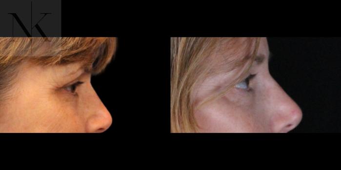 Before & After Brow Lift Case 158 Right Side View in Wethersfield, Hartford, Nebraska