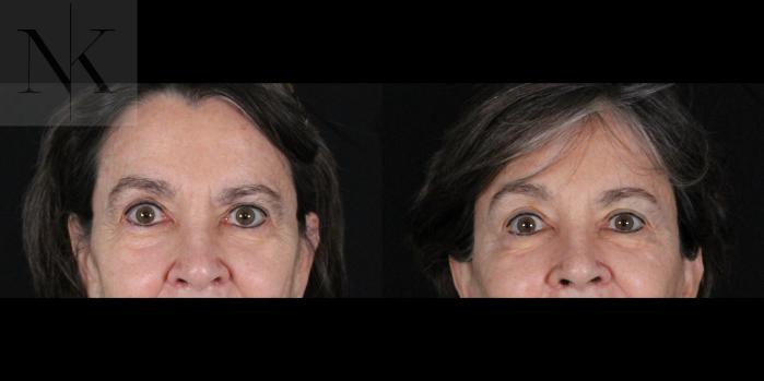 Before & After Brow Lift Case 159 Front View in Wethersfield, Hartford, Nebraska