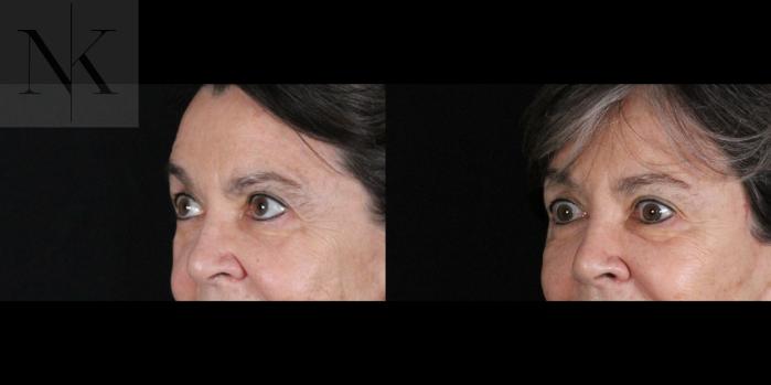 Before & After Brow Lift Case 159 Left Oblique View in Wethersfield, Hartford, Nebraska