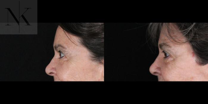 Before & After Brow Lift Case 159 Left Side View in Wethersfield, Hartford, Nebraska