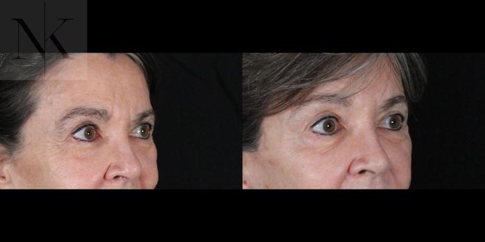 Before & After Brow Lift Case 159 Right Oblique View in Wethersfield, Hartford, Nebraska