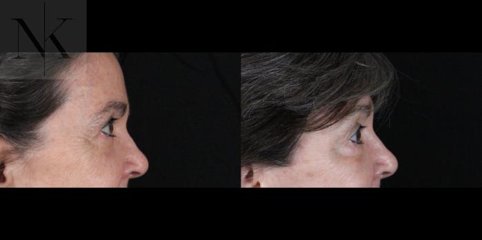 Before & After Brow Lift Case 159 Right Side View in Wethersfield, Hartford, Nebraska