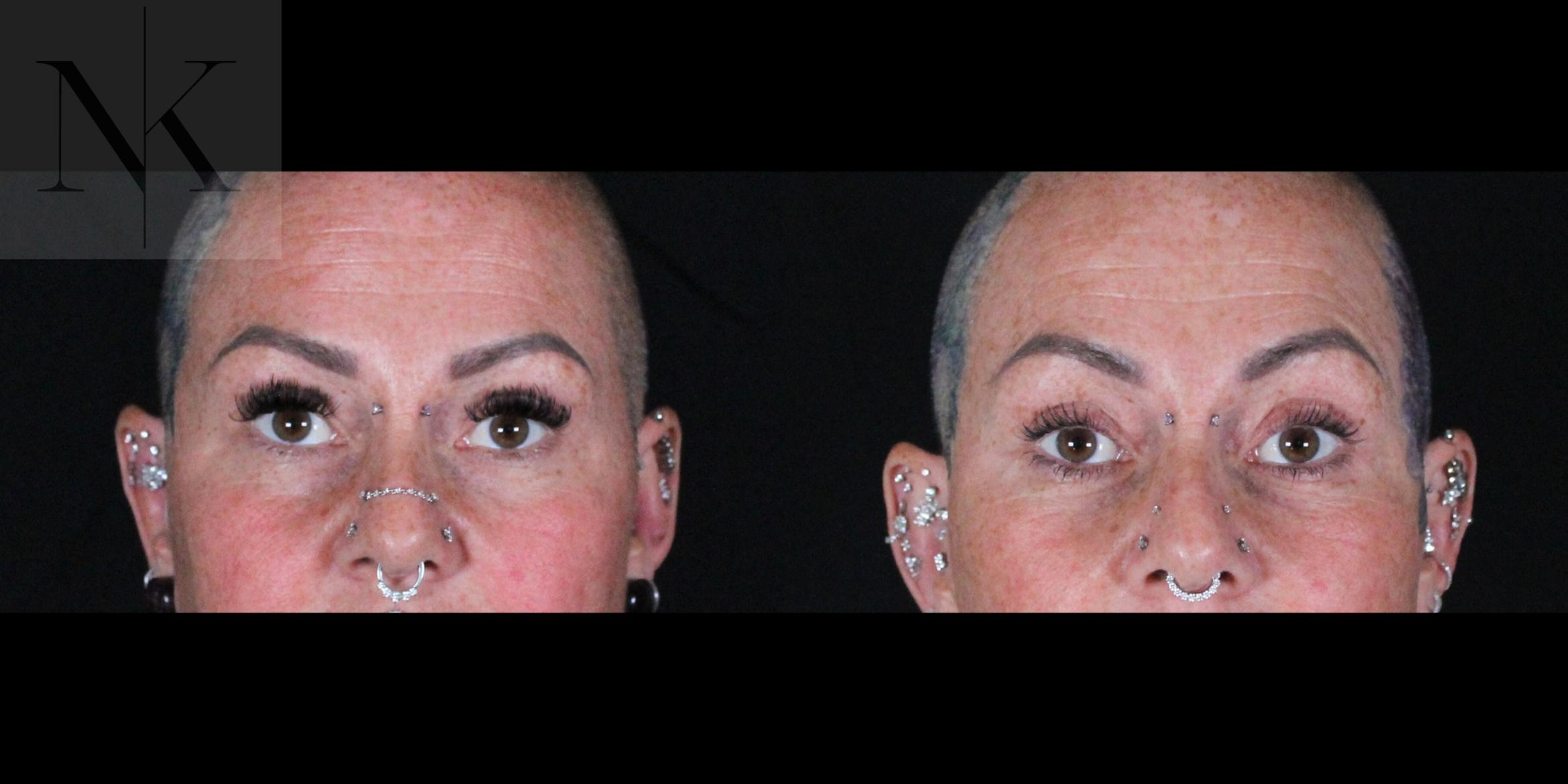 Before & After Brow Lift Case 160 Front View in Wethersfield, Hartford, Nebraska