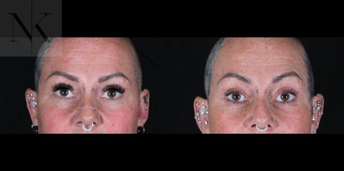 Before & After Brow Lift Case 160 Front View in Wethersfield, Hartford, Nebraska