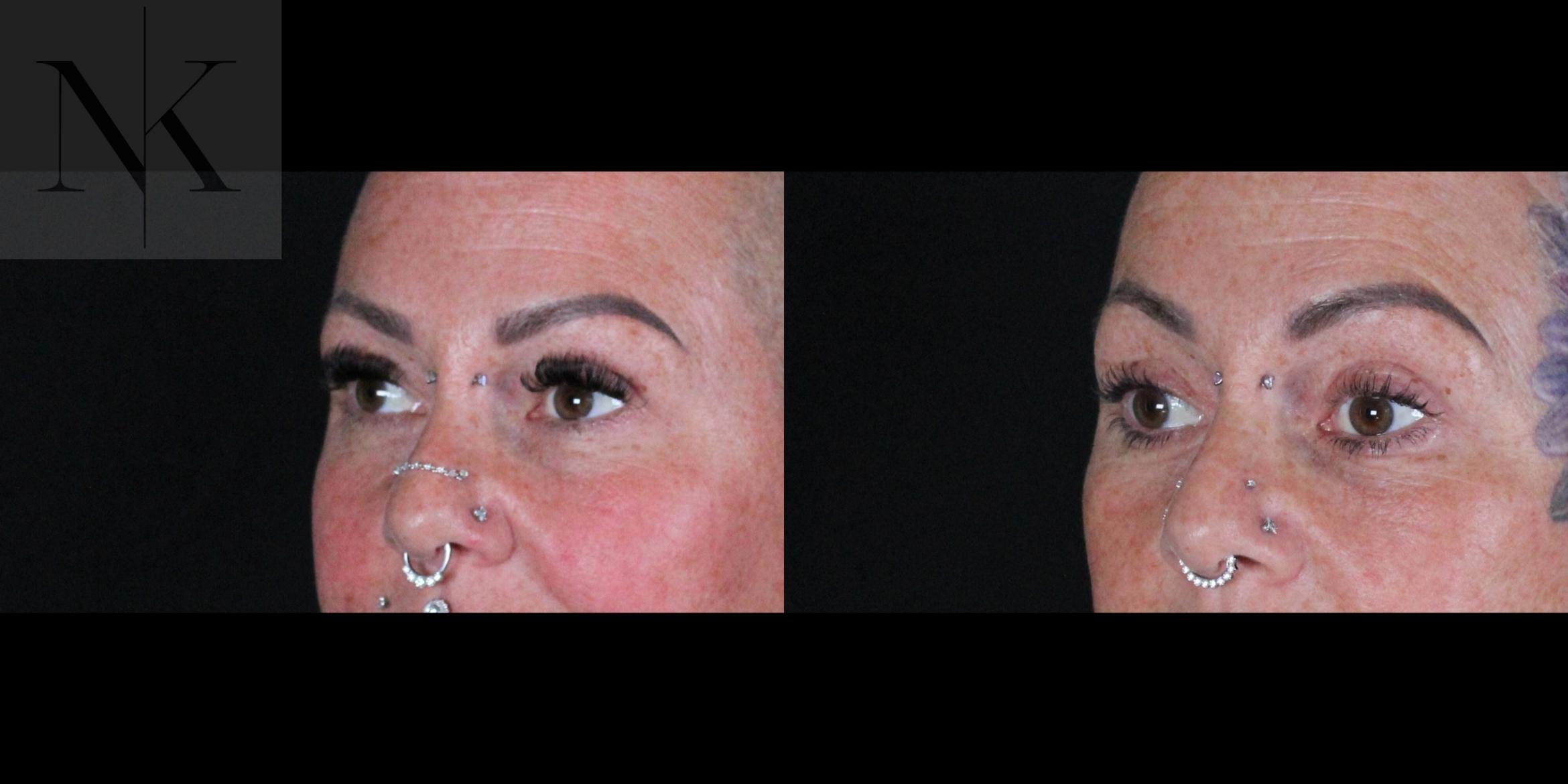 Before & After Brow Lift Case 160 Left Oblique View in Wethersfield, Hartford, Nebraska