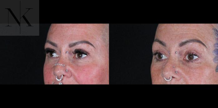 Before & After Brow Lift Case 160 Left Oblique View in Wethersfield, Hartford, Nebraska