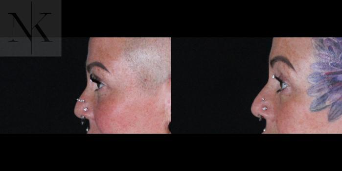 Before & After Brow Lift Case 160 Left Side View in Wethersfield, Hartford, Nebraska