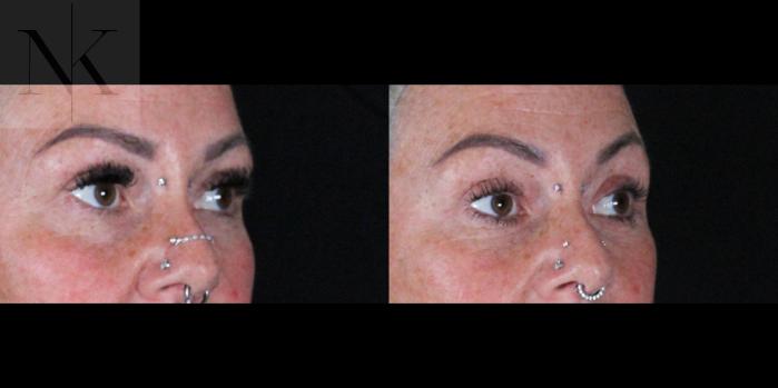 Before & After Brow Lift Case 160 Right Oblique View in Wethersfield, Hartford, Nebraska