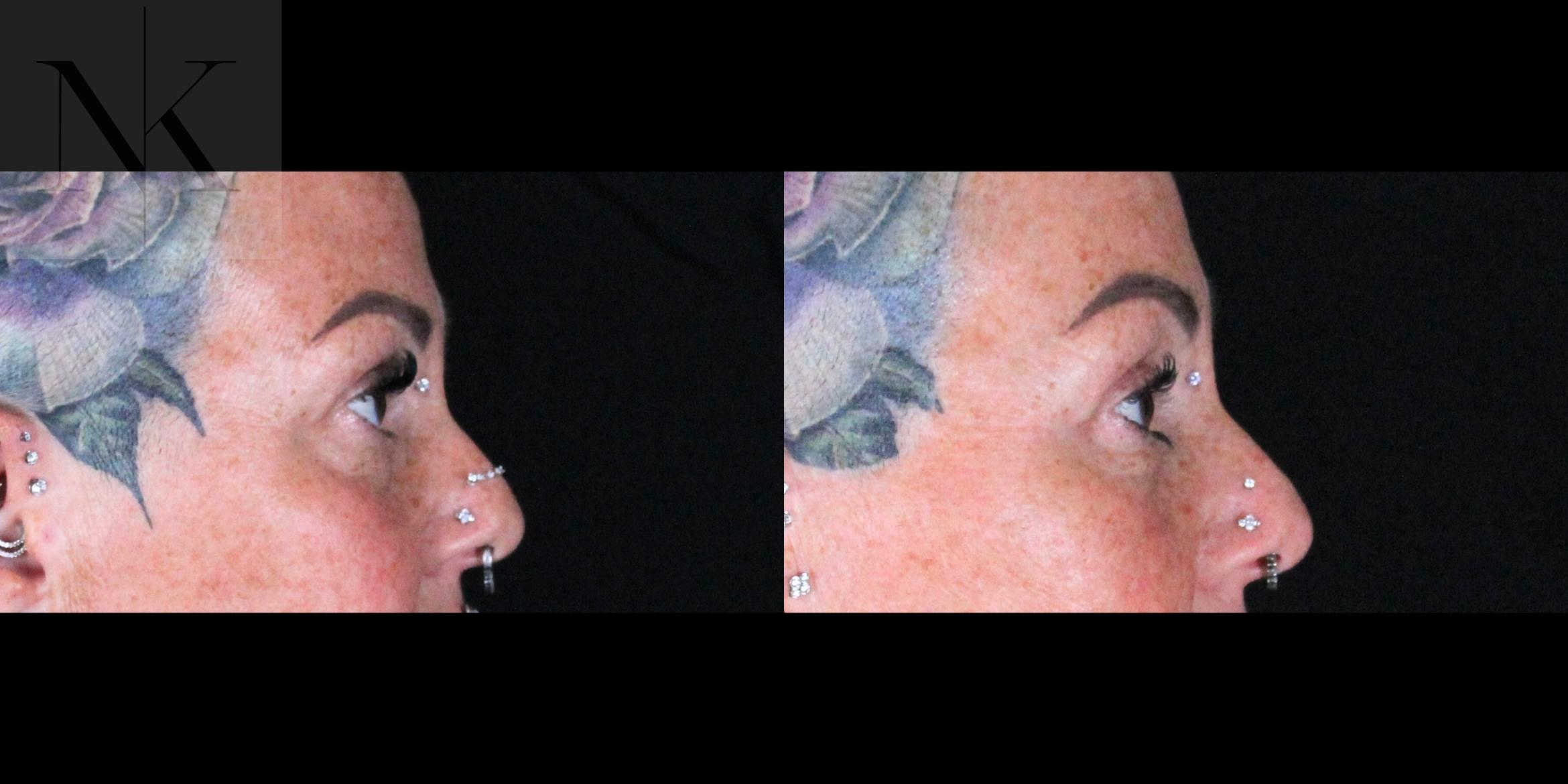 Before & After Brow Lift Case 160 Right Side View in Wethersfield, Hartford, Nebraska