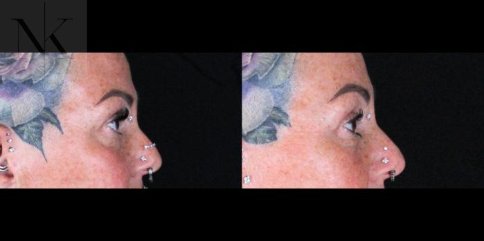 Before & After Brow Lift Case 160 Right Side View in Wethersfield, Hartford, Nebraska