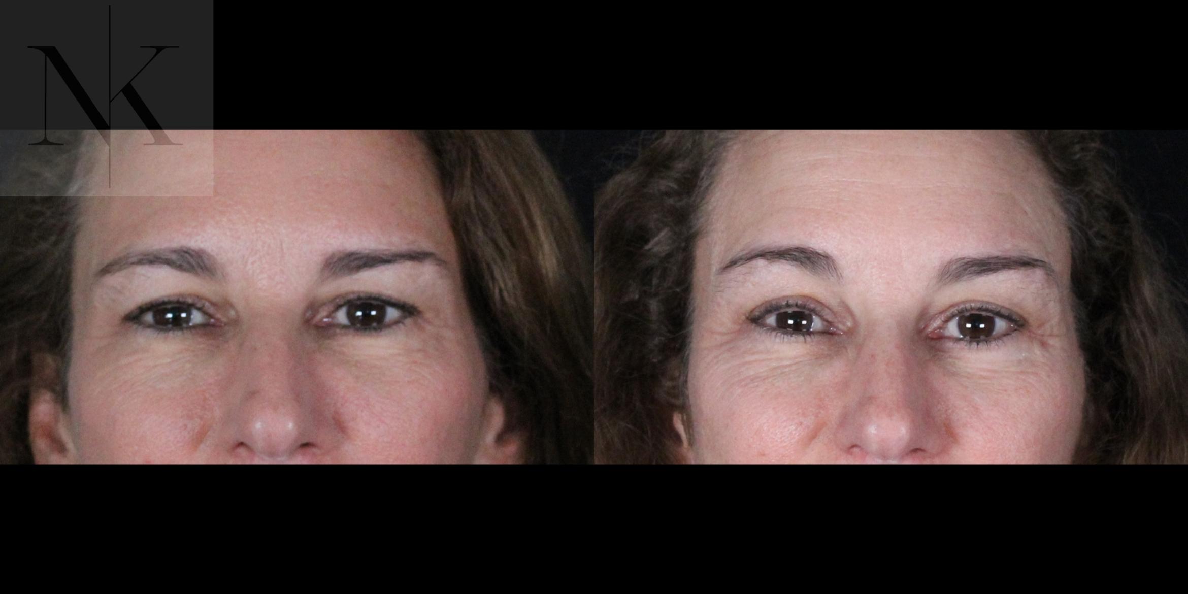 Before & After Brow Lift Case 161 Front View in Wethersfield, Hartford, Nebraska