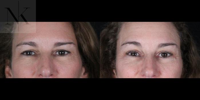 Before & After Brow Lift Case 161 Front View in Wethersfield, Hartford, Nebraska