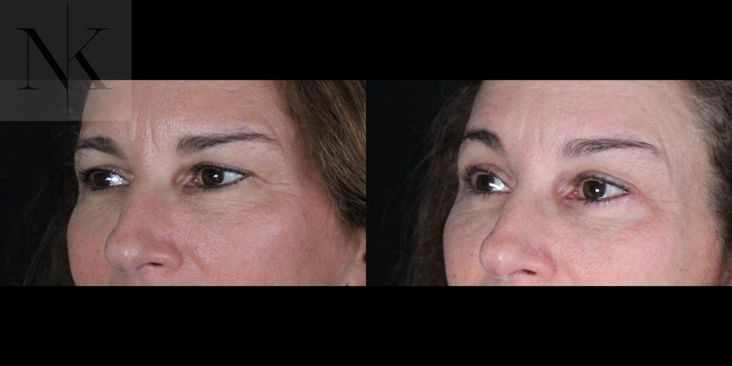 Before & After Brow Lift Case 161 Left Oblique View in Wethersfield, Hartford, Nebraska