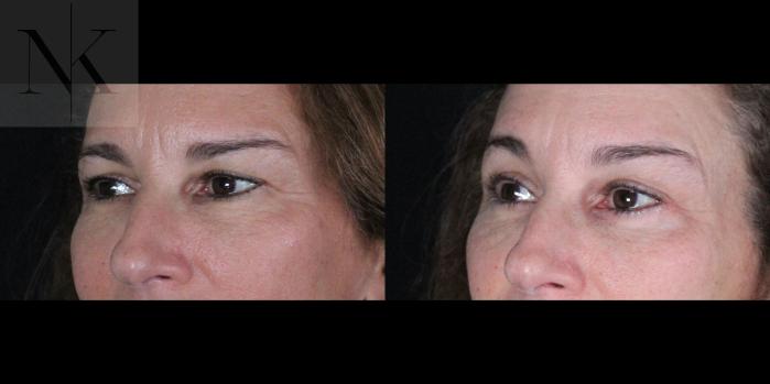 Before & After Brow Lift Case 161 Left Oblique View in Wethersfield, Hartford, Nebraska