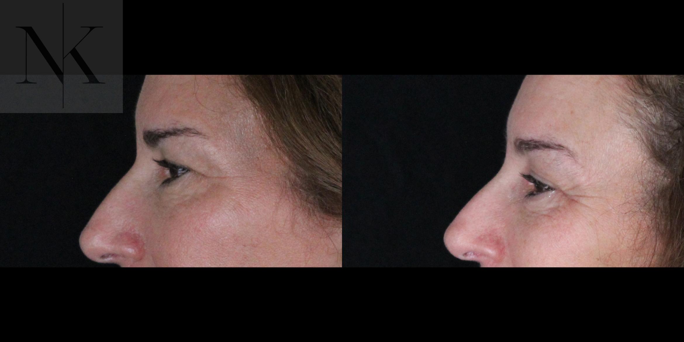 Before & After Brow Lift Case 161 Left Side View in Wethersfield, Hartford, Nebraska
