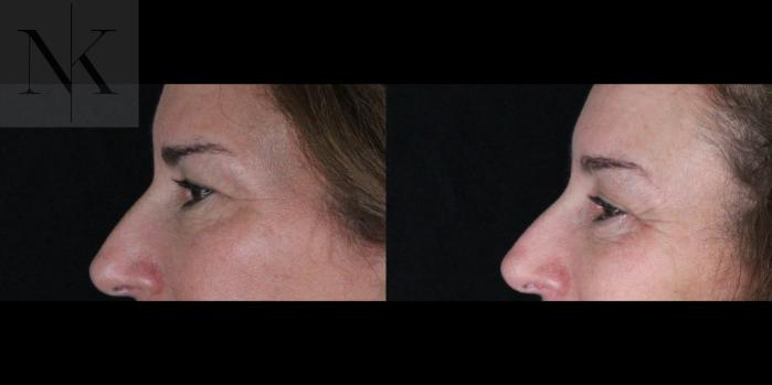 Before & After Brow Lift Case 161 Left Side View in Wethersfield, Hartford, Nebraska