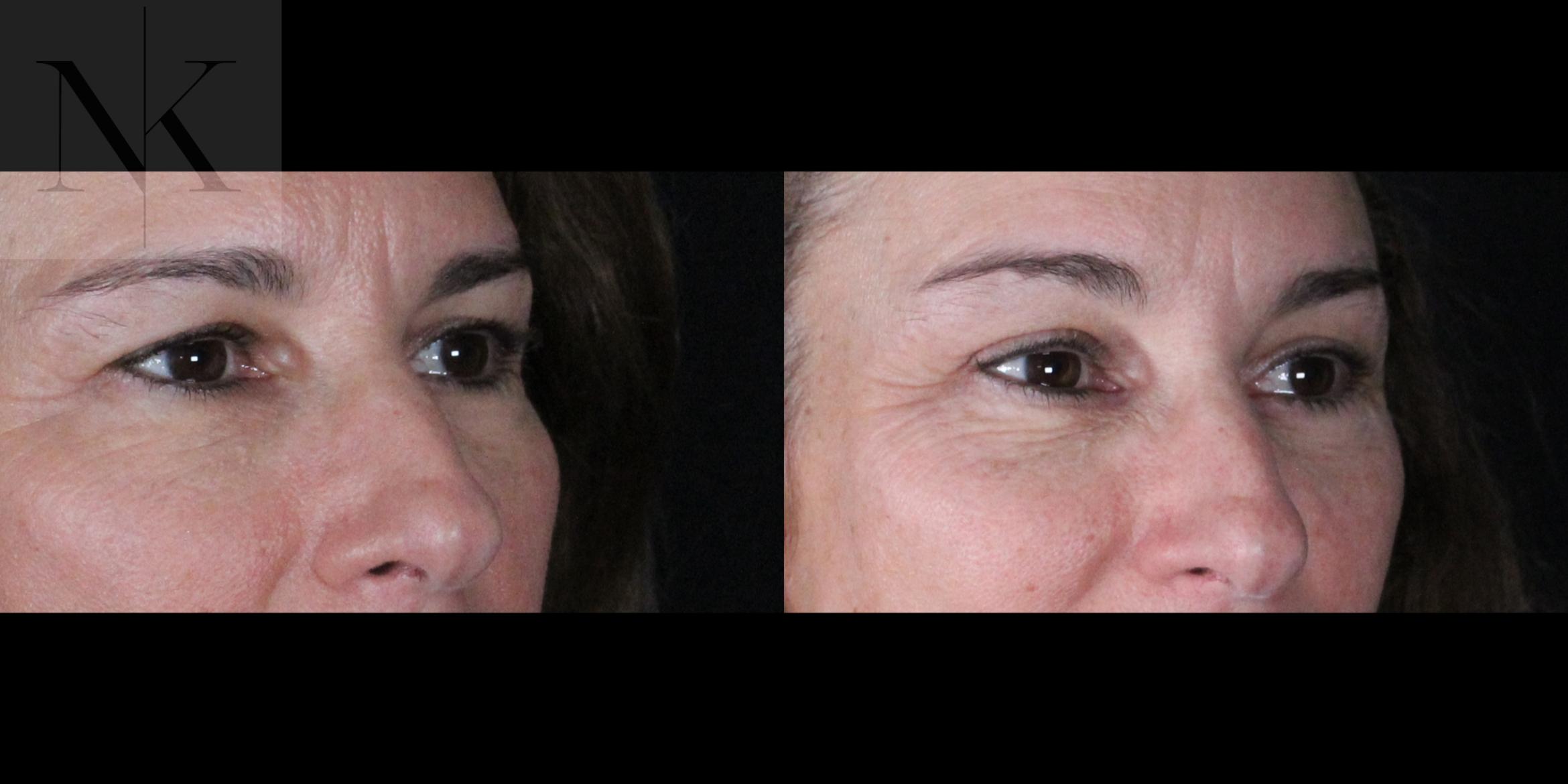 Before & After Brow Lift Case 161 Right Oblique View in Wethersfield, Hartford, Nebraska