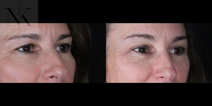 Before & After Brow Lift Case 161 Right Oblique View in Wethersfield, Hartford, Nebraska