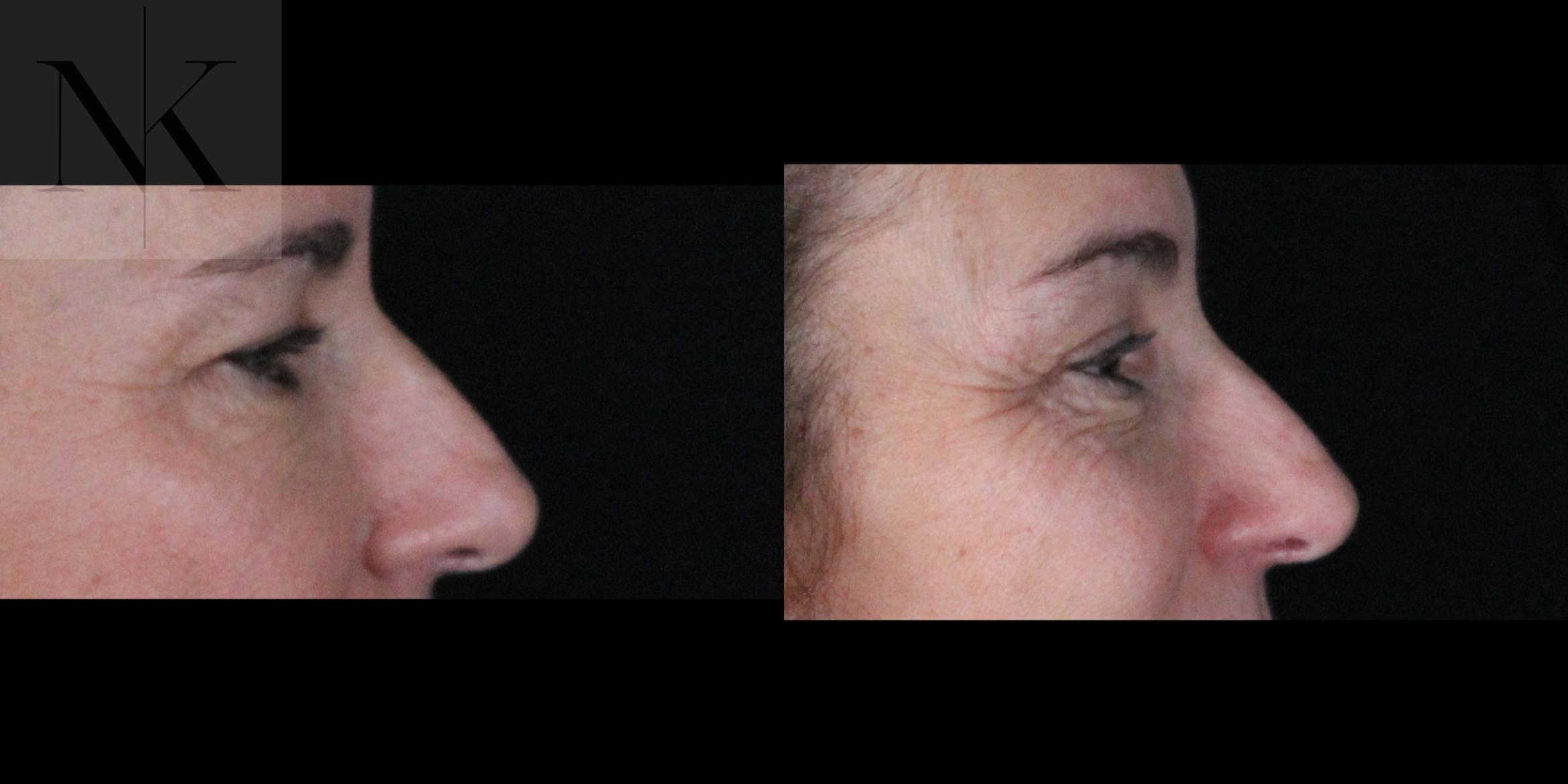 Before & After Brow Lift Case 161 Right Side View in Wethersfield, Hartford, Nebraska
