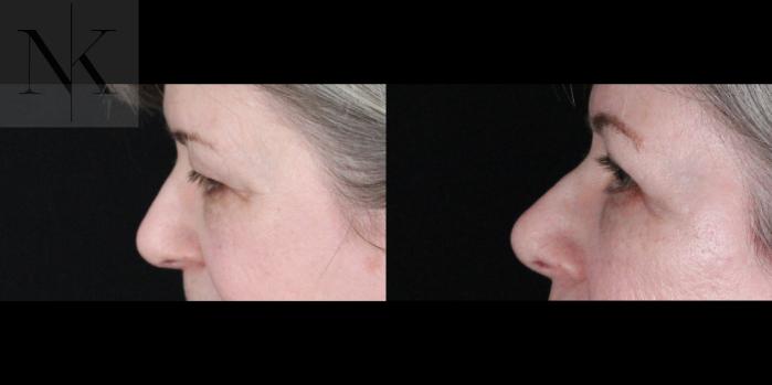 Before & After Brow Lift Case 162 Left Side View in Wethersfield, Hartford, Nebraska