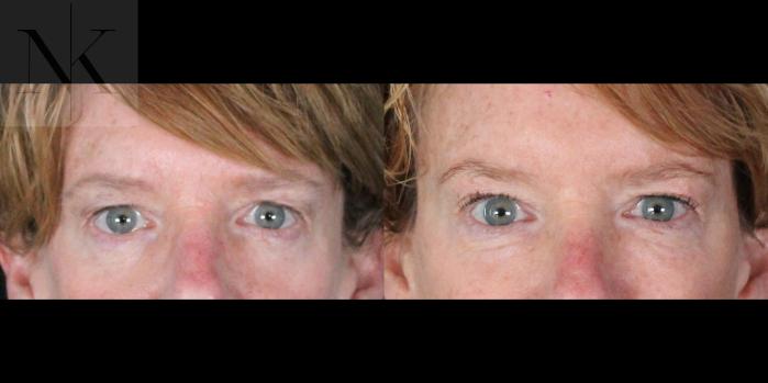 Before & After Brow Lift Case 163 Front View in Wethersfield, Hartford, Nebraska