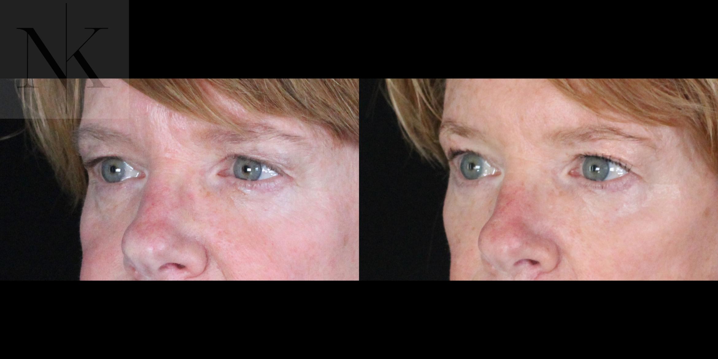 Before & After Brow Lift Case 163 Left Oblique View in Wethersfield, Hartford, Nebraska