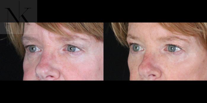 Before & After Brow Lift Case 163 Left Oblique View in Wethersfield, Hartford, Nebraska