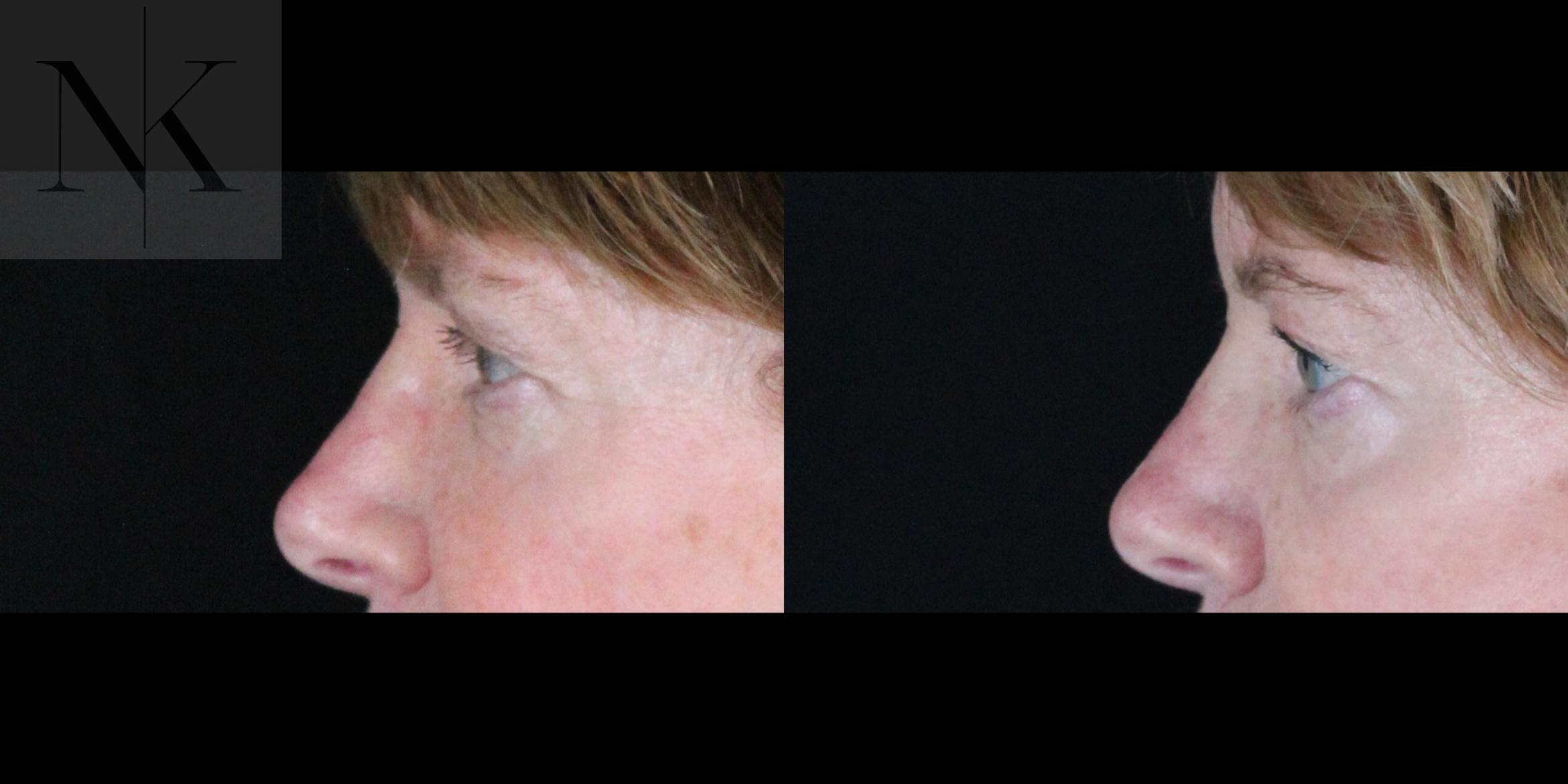 Before & After Brow Lift Case 163 Left Side View in Wethersfield, Hartford, Nebraska