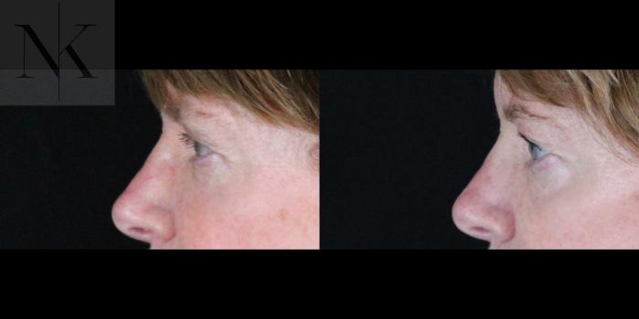 Before & After Brow Lift Case 163 Left Side View in Wethersfield, Hartford, Nebraska