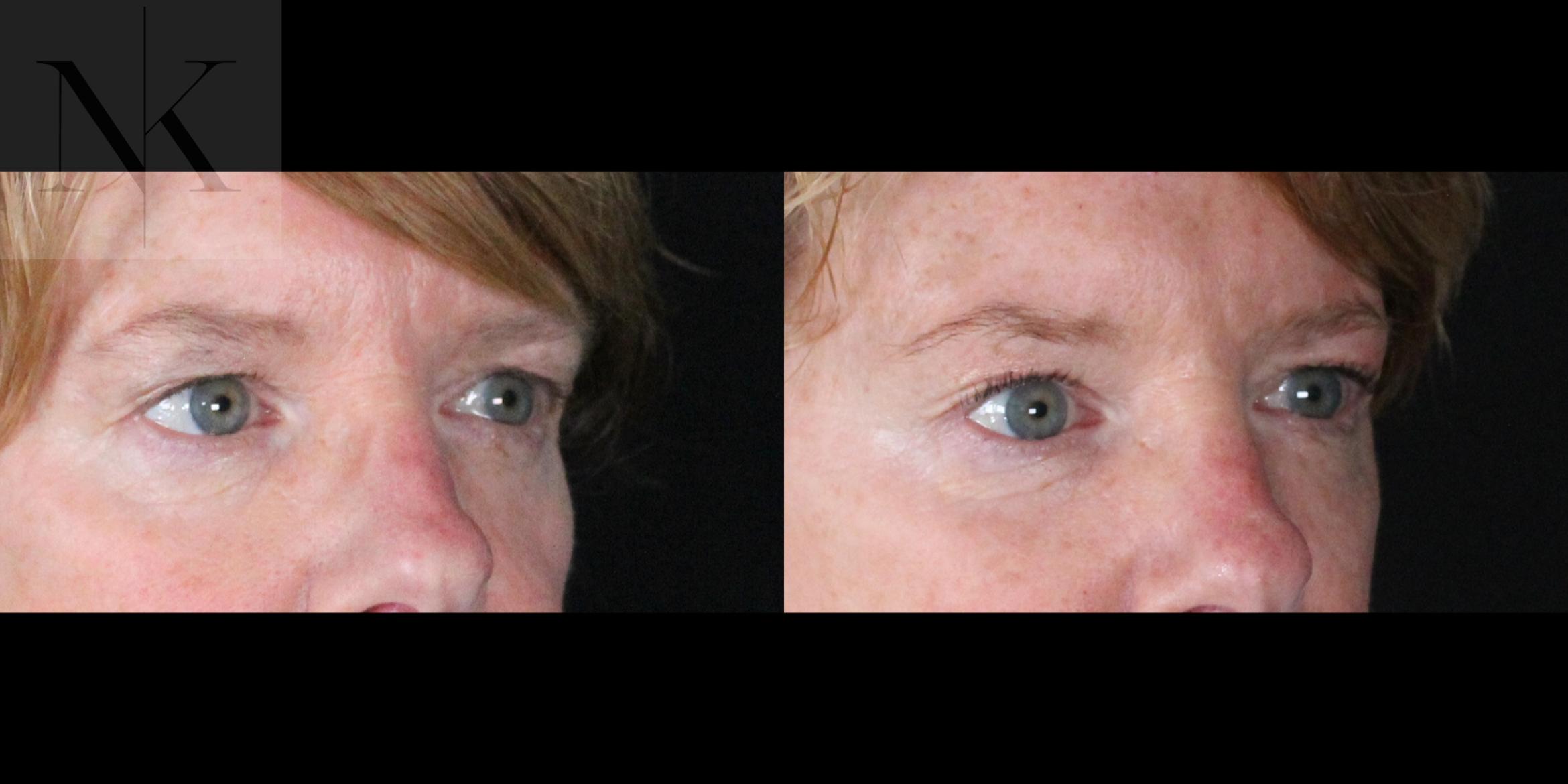 Before & After Brow Lift Case 163 Right Oblique View in Wethersfield, Hartford, Nebraska