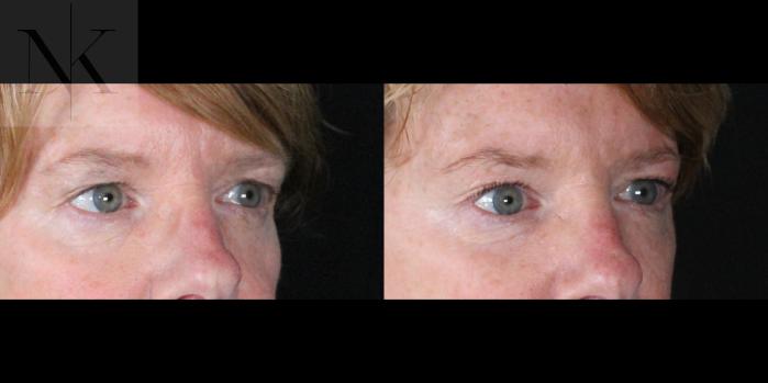 Before & After Brow Lift Case 163 Right Oblique View in Wethersfield, Hartford, Nebraska