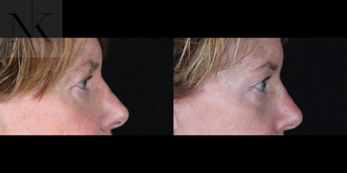 Before & After Brow Lift Case 163 Right Side View in Wethersfield, Hartford, Nebraska